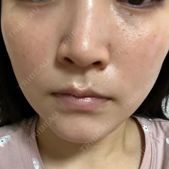 ルメッカ L‘amour clinic Tokyo【ラムールクリニック東京】 AFTER メイン用