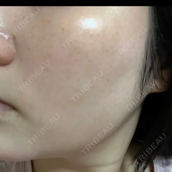 ルメッカ L‘amour clinic Tokyo【ラムールクリニック東京】 DAY 3 メイン用