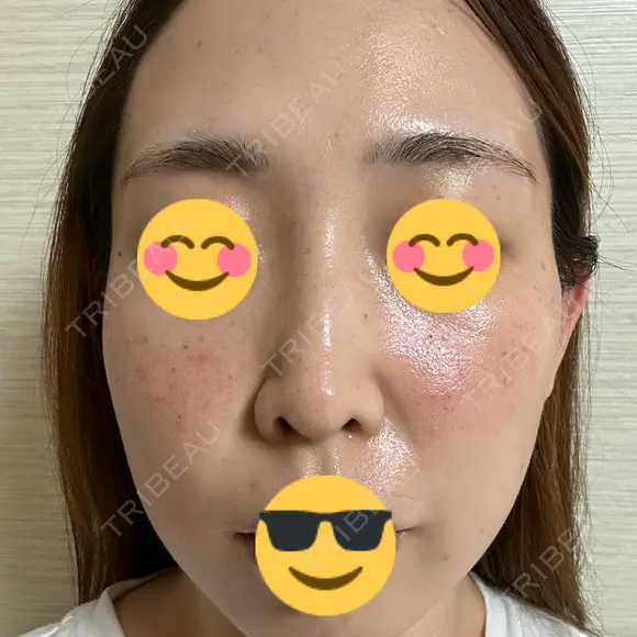 光治療（フォトフェイシャルなど） / ピーリング（ハリ・ツヤ） 東京美容クリニック 表参道本院 DAY 1 メイン用