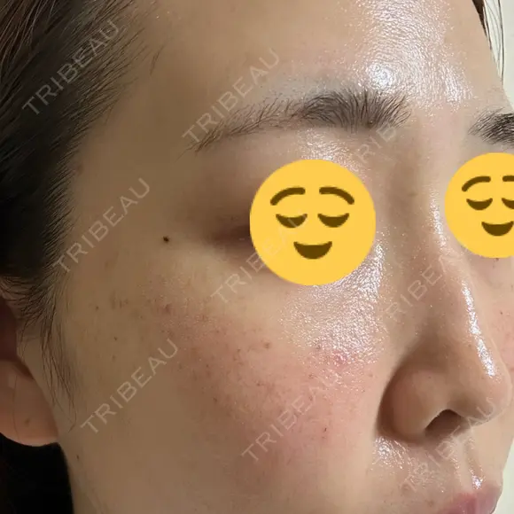 光治療（フォトフェイシャルなど） / ピーリング（ハリ・ツヤ） 東京美容クリニック 表参道本院 DAY 1 メイン用