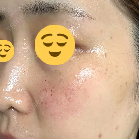 光治療（フォトフェイシャルなど） / ピーリング（ハリ・ツヤ） 東京美容クリニック 表参道本院 DAY 1 メイン用