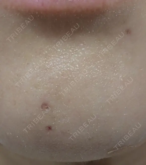 ほくろ・いぼ除去レーザー（肌） プライベートスキンクリニック 梅田本院 DAY 6 メイン用