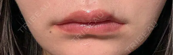 ヒアルロン酸注入（唇） 目白ホワイトクリニック AFTER メイン用