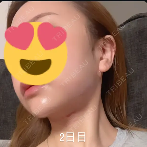 糸リフト / バッカルファット除去 / 脂肪吸引（顔） 札幌美容外科ネビュラクリニック DAY 1 メイン用
