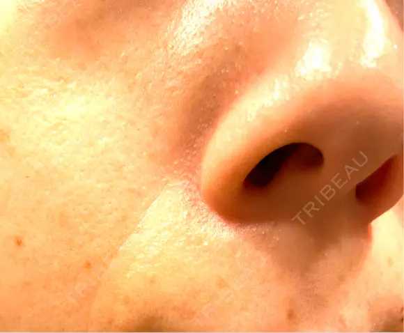 医療脱毛（顔） / 医療脱毛（全身） 共立美容外科 仙台院 AFTER メイン用