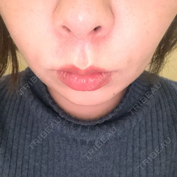 ヒアルロン酸注入（頬） ギャラリークリニック 横浜院 AFTER メイン用