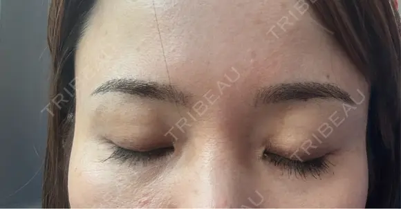 アートメイク（眉） 表参道メディカルクリニック 広島院 DAY 1 メイン用