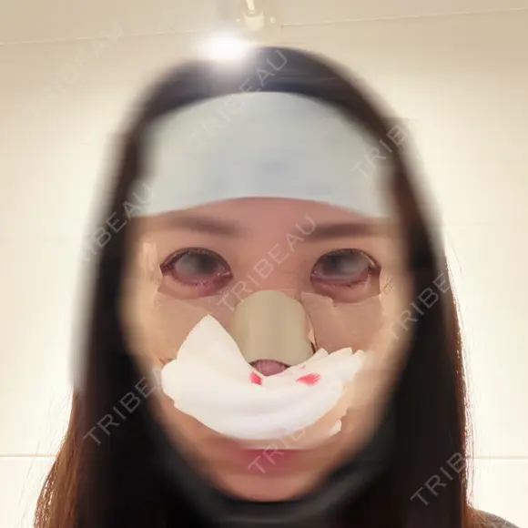 二重埋没 / 隆鼻術 / 鼻尖形成（切開） / 鼻中隔延長（切開） / 小鼻縮小（切開） / クマ治療 / 目尻切開 / 軟骨移植 / 鼻柱下降・鼻唇角形成（猫手術） WOM CLINIC GINZA （ワム クリニック ギンザ） AFTER メイン用