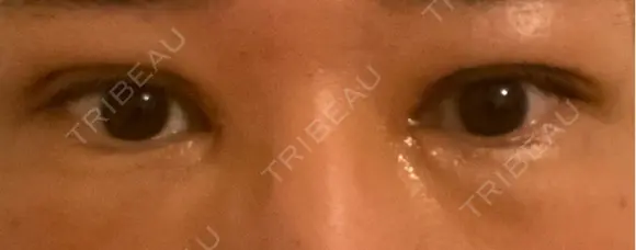 二重埋没 / 目頭切開 eクリニック 横浜みなとみらい院 DAY 8 メイン用