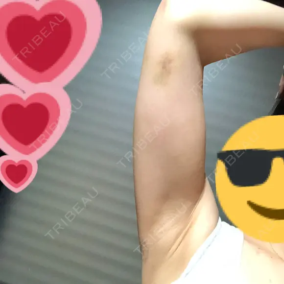 脂肪吸引（二の腕） / 脂肪溶解注射（二の腕） THE SKINNY CLINIC（ザ・スキニークリニック） DAY 11 メイン用