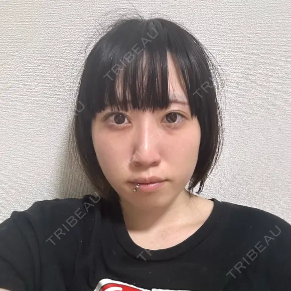 糸リフト MKクリニック 日本橋院 DAY 2 メイン用