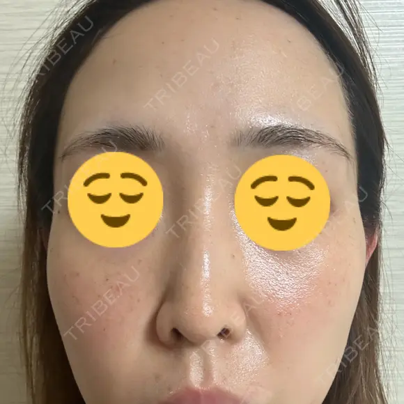 光治療（フォトフェイシャルなど） / ピーリング（ハリ・ツヤ） 東京美容クリニック 表参道本院 DAY 3 メイン用