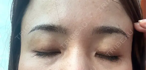 アートメイク（眉） 表参道メディカルクリニック 広島院 DAY 2 メイン用