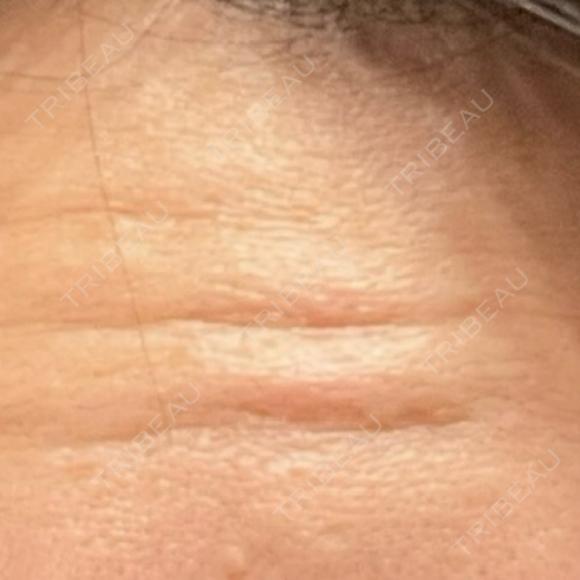 ボトックス（額） FIG CLINIC AFTER メイン用