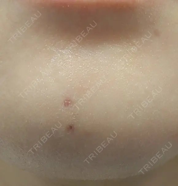 ほくろ・いぼ除去レーザー（肌） プライベートスキンクリニック 梅田本院 DAY 8 メイン用