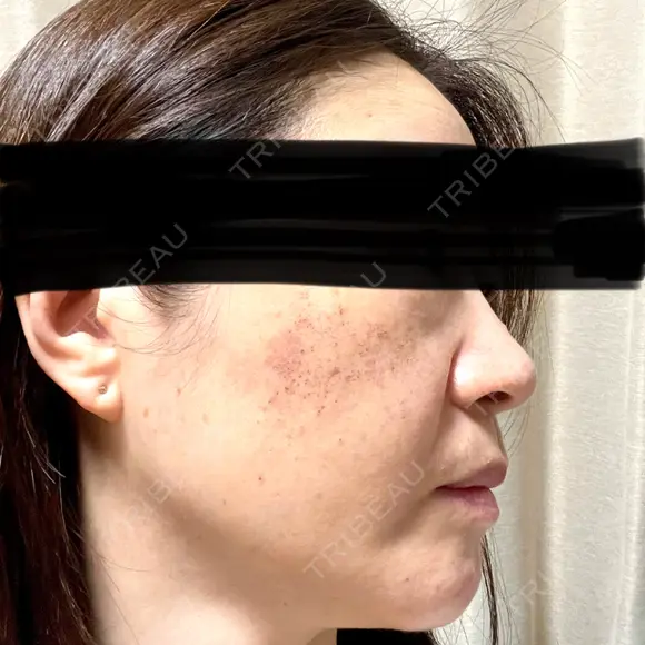 ルメッカ 東京シルククリニック 東京神田院 DAY 3 メイン用