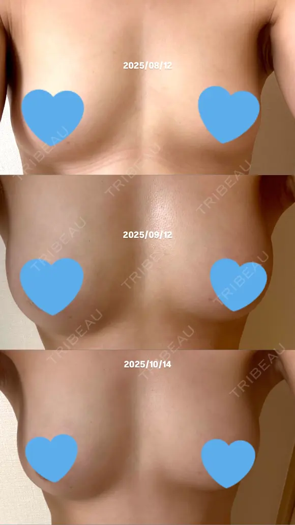 豊胸（脂肪注入） Lipo Clinic omotesando DAY 63 メイン用