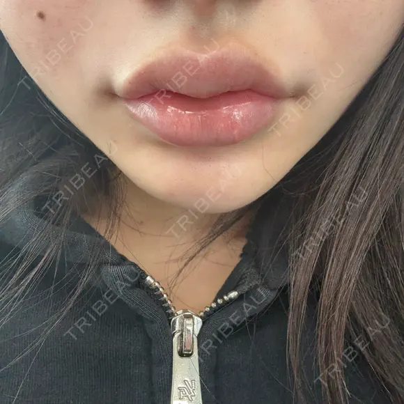 ヒアルロン酸注入（唇） 目白ホワイトクリニック DAY 0 メイン用