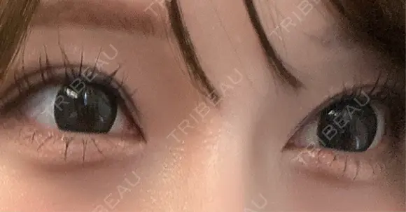 ヒアルロン酸注入（涙袋） / ヒアルロン酸注入（唇） EMMO FACE CLINIC 東京三田院 AFTER メイン用