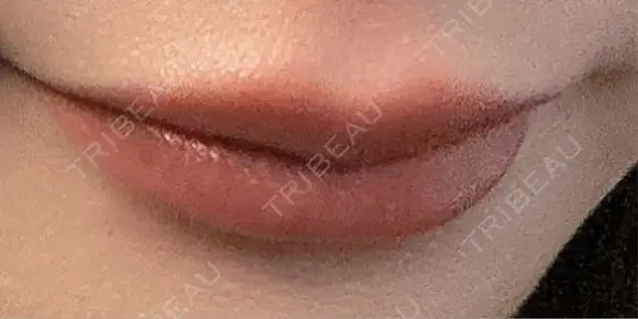 ヒアルロン酸注入（涙袋） / ヒアルロン酸注入（唇） EMMO FACE CLINIC 東京三田院 DAY 13 メイン用