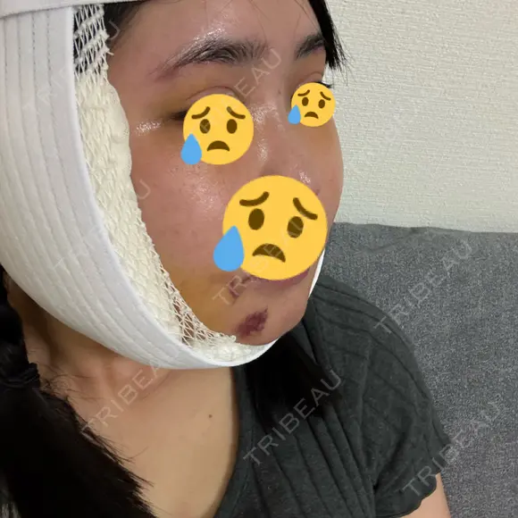 骨切り（あご） / 骨削り（エラ） / 骨削り（頬） リッツ美容外科 東京院 DAY 8 メイン用