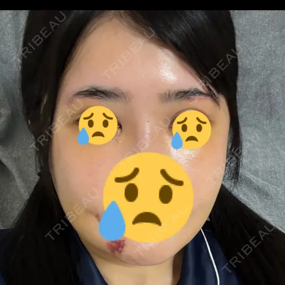 骨切り（あご） / 骨削り（エラ） / 骨削り（頬） リッツ美容外科 東京院 DAY 10 メイン用