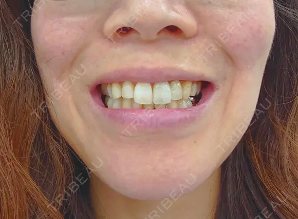 セラミック / その他（審美歯科/矯正歯科） 東京美容外科 赤坂院 AFTER メイン用
