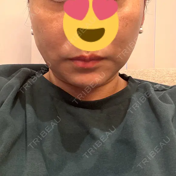 糸リフト / 脂肪吸引注射（顔） 新宿美容外科ネビュラクリニック DAY 28 メイン用