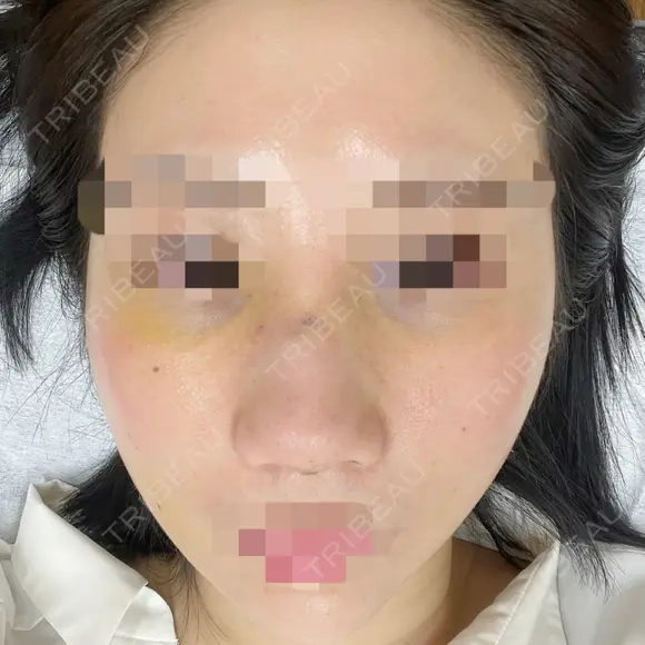 鼻尖形成（切開） / 鼻中隔延長（切開） / 軟骨移植 / 骨切幅寄せ / ワシ鼻修正・ハンプ切除 / 斜鼻修正 / 鼻修正 リッツ美容外科 東京院 DAY 6 メイン用