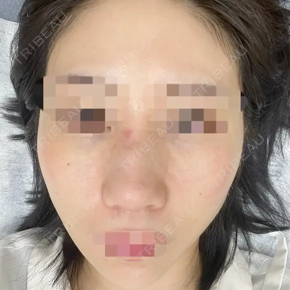 鼻尖形成（切開） / 鼻中隔延長（切開） / 軟骨移植 / 骨切幅寄せ / ワシ鼻修正・ハンプ切除 / 斜鼻修正 / 鼻修正 リッツ美容外科 東京院 DAY 11 メイン用