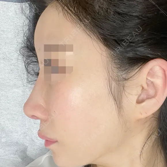 鼻尖形成（切開） / 鼻中隔延長（切開） / 軟骨移植 / 骨切幅寄せ / ワシ鼻修正・ハンプ切除 / 斜鼻修正 / 鼻修正 リッツ美容外科 東京院 DAY 11 メイン用