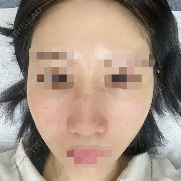 鼻尖形成（切開） / 鼻中隔延長（切開） / 軟骨移植 / 骨切幅寄せ / ワシ鼻修正・ハンプ切除 / 斜鼻修正 / 鼻修正 リッツ美容外科 東京院 DAY 16 メイン用