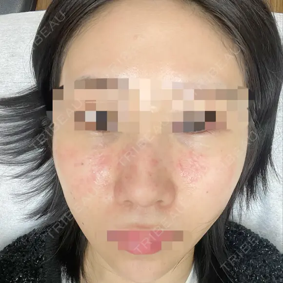 鼻尖形成（切開） / 鼻中隔延長（切開） / 軟骨移植 / 骨切幅寄せ / ワシ鼻修正・ハンプ切除 / 斜鼻修正 / 鼻修正 リッツ美容外科 東京院 DAY 21 メイン用