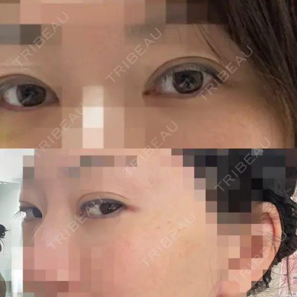 ヒアルロン酸注入（涙袋） / ヒアルロン酸注入（こめかみ） DMTC CLINIC 日本橋院 DAY 0 メイン用