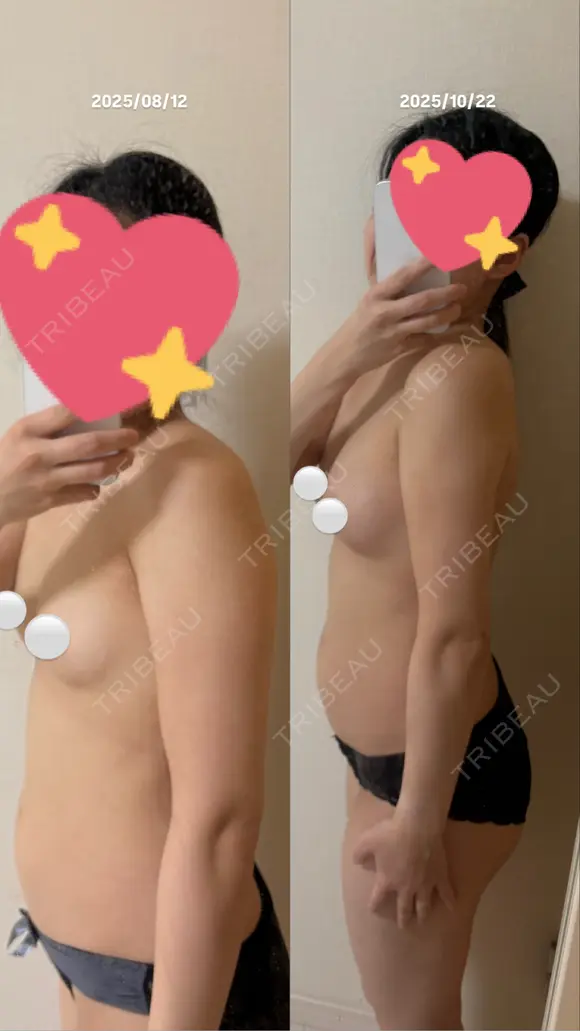 豊胸（脂肪注入） Lipo Clinic omotesando DAY 71 メイン用