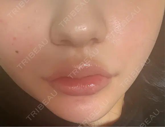 ヒアルロン酸注入（唇） 目白ホワイトクリニック DAY 1 メイン用