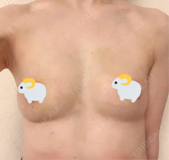 豊胸（脂肪注入） / 脂肪注入（額） / 乳頭縮小 アールクリニック DAY 15 メイン用