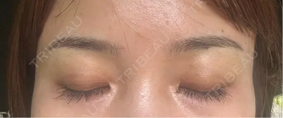 アートメイク（眉） 表参道メディカルクリニック 広島院 DAY 5 メイン用