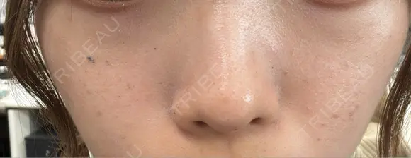 ボトックス（口角） / 毛穴洗浄（ハイドラフェイシャルなど） / ルメッカ 東京シルククリニック 東京神田院 AFTER メイン用