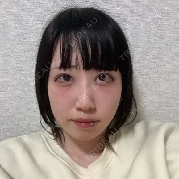 糸リフト MKクリニック 日本橋院 DAY 6 メイン用