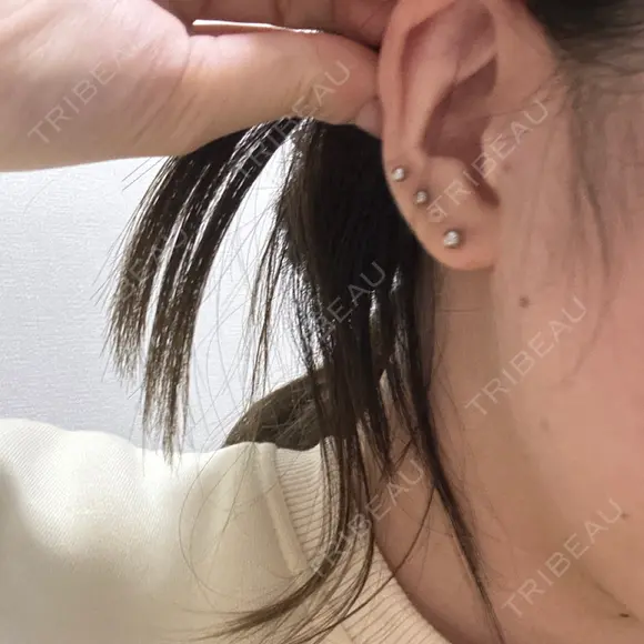 糸リフト MKクリニック 日本橋院 DAY 6 メイン用