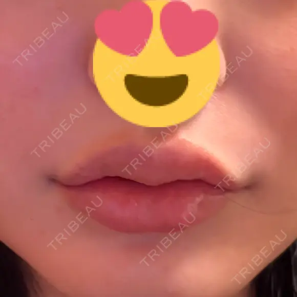 ヒアルロン酸注入（唇） 目白ホワイトクリニック AFTER メイン用