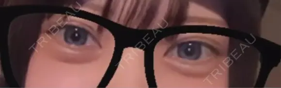 ヒアルロン酸注入（涙袋） / ヒアルロン酸注入（唇） / ボトックス（口角） AI Beauty Clinic （エーアイ美容クリニック） AFTER メイン用