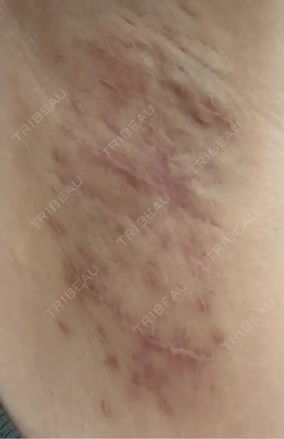 ワキ汗治療（切開） 石倉クリニック 水戸院 DAY 102 メイン用