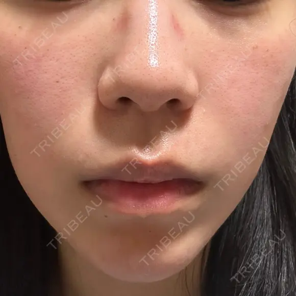 ルメッカ ルラ美容クリニック 札幌本院 DAY 2 メイン用