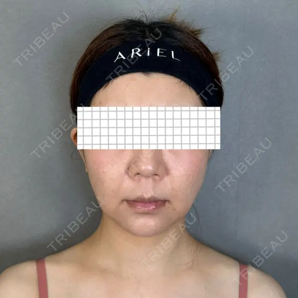 バッカルファット除去 アリエル美容クリニック 大宮院 AFTER メイン用