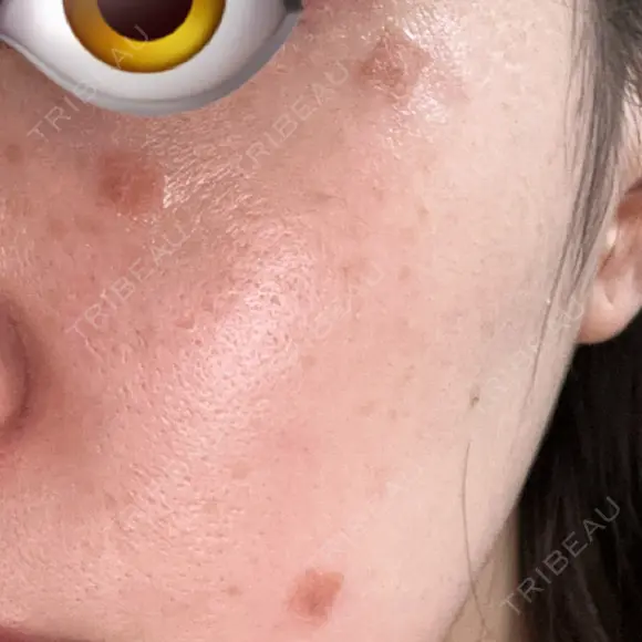 ほくろ・いぼ切除（肌） 心斎橋KT美容クリニック DAY 0 メイン用