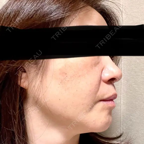 ルメッカ 東京シルククリニック 東京神田院 DAY 8 メイン用