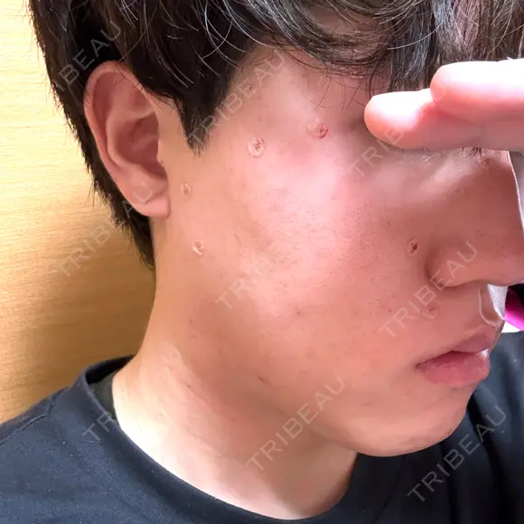 ほくろ・いぼ除去レーザー（肌） 共立美容外科 福岡院 DAY 0 メイン用