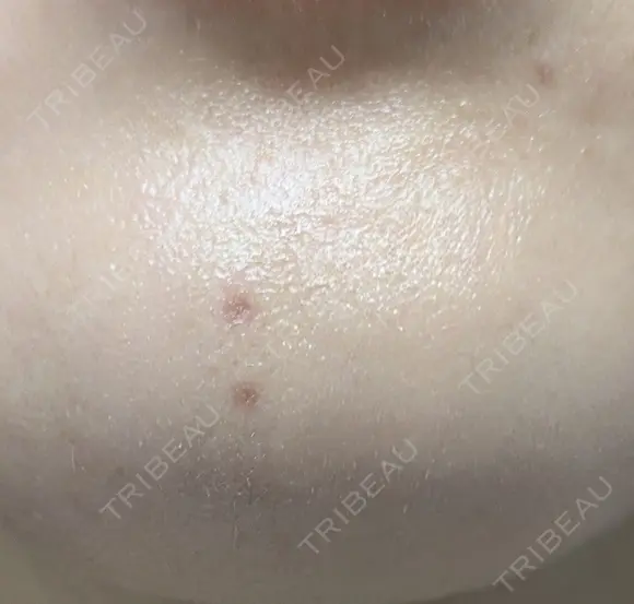 ほくろ・いぼ除去レーザー（肌） プライベートスキンクリニック 梅田本院 DAY 14 メイン用